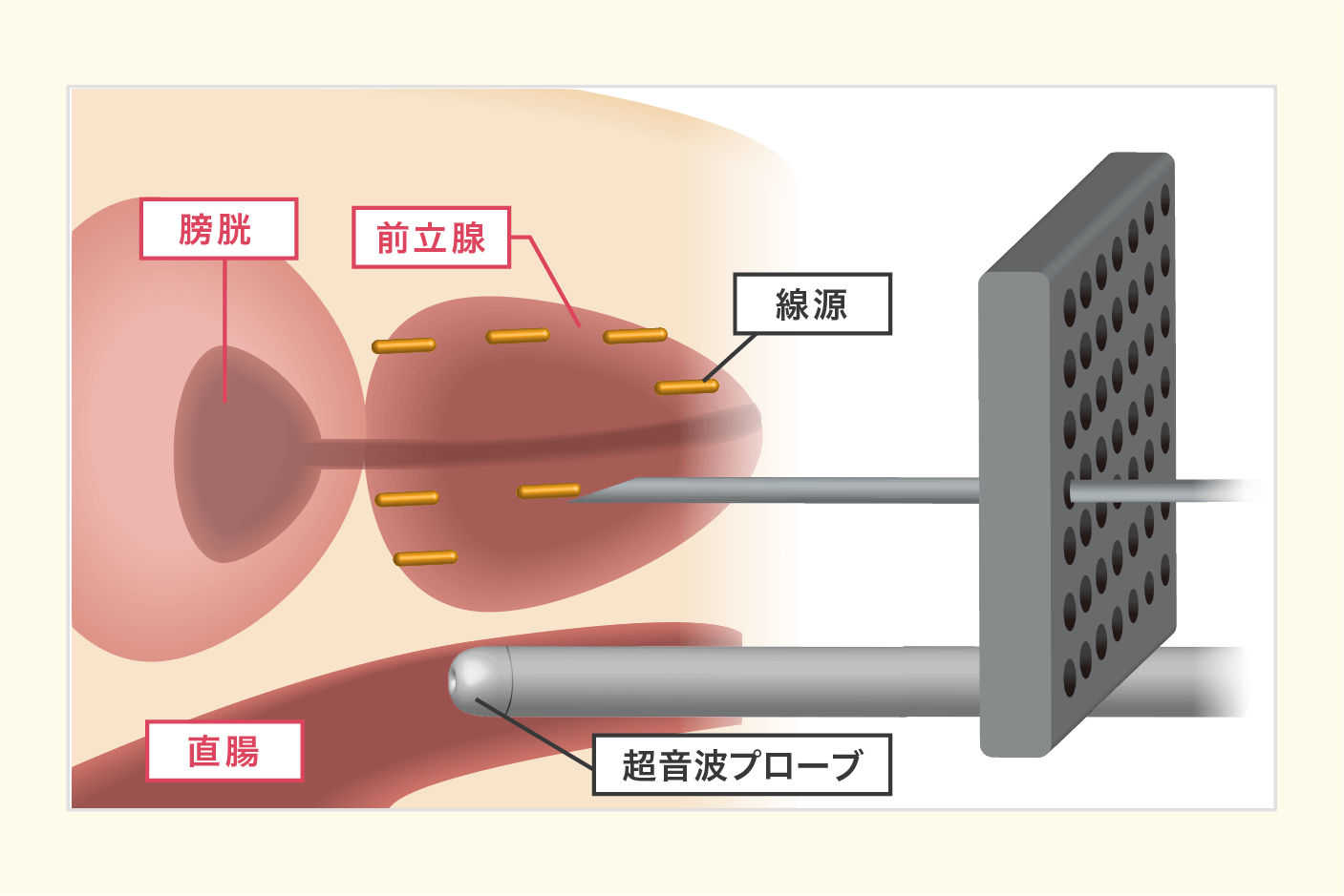 前立腺がんの小線源治療とは何ですか?