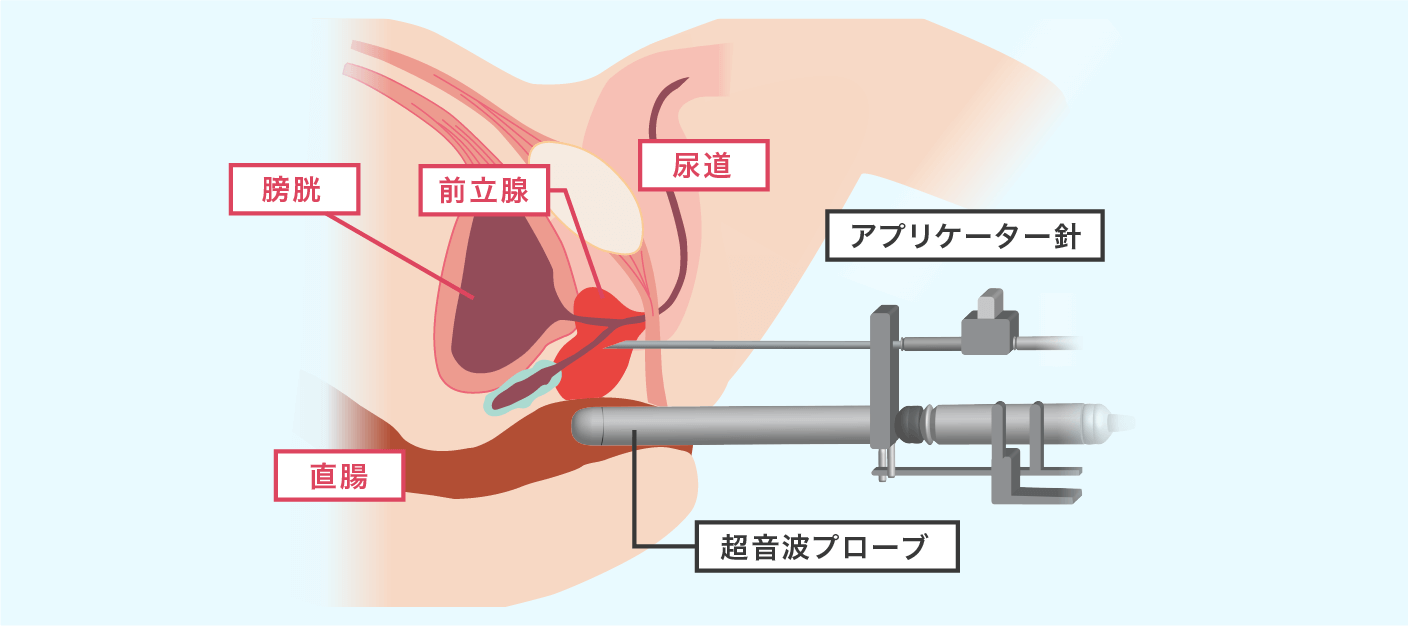 小線源治療のイメージ画像