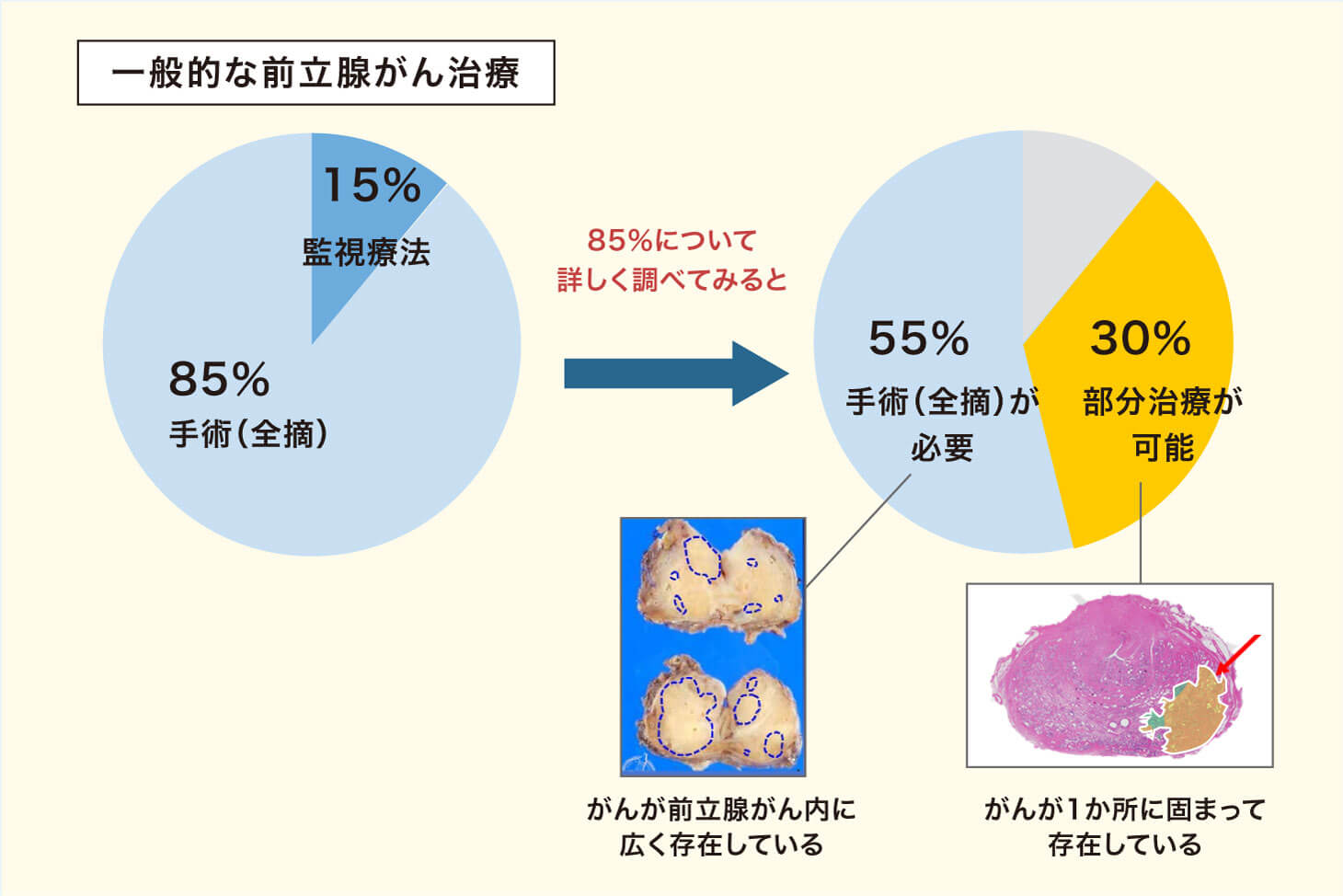 前立腺がんの30%は前立腺部分治療が可能