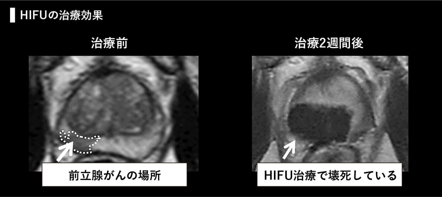 HIFUの治療効果の治療前と治療2週間後の画像