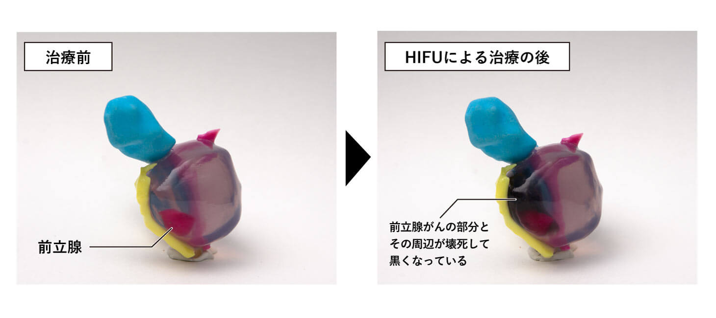 HIFUの治療の前後をモデルで示した画像