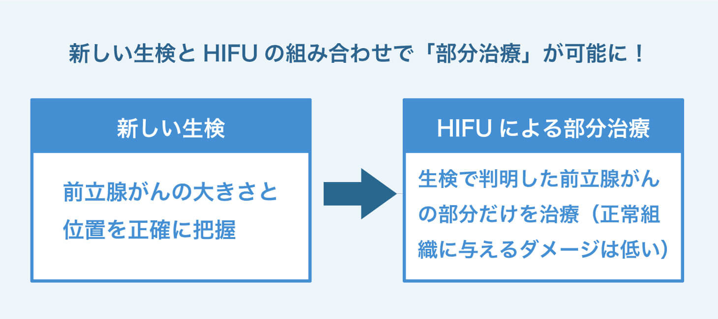 前立腺がんのみを治療する「部分治療」が可能になるということを示した画像