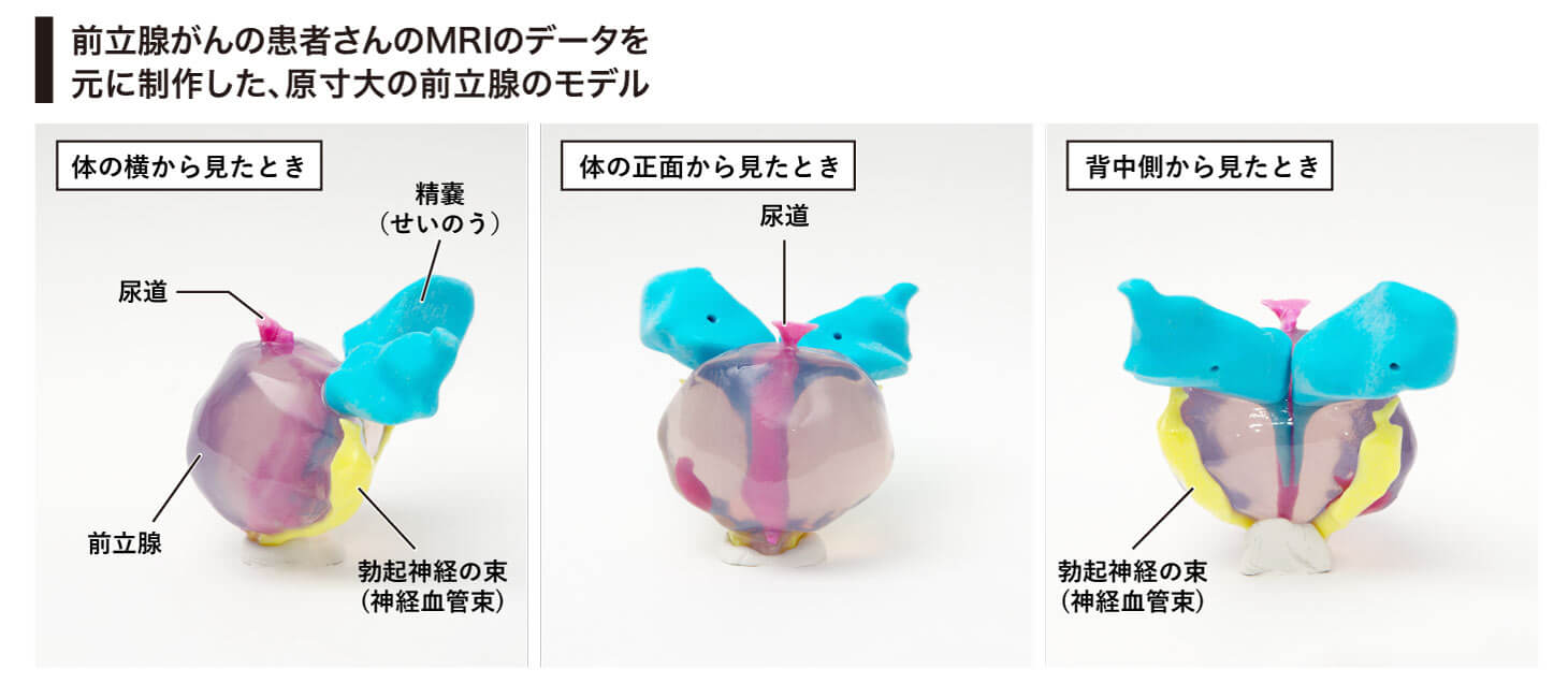 前立腺のモデル