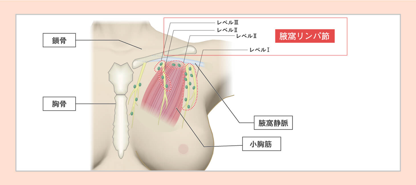 腋窩リンパ節の郭清