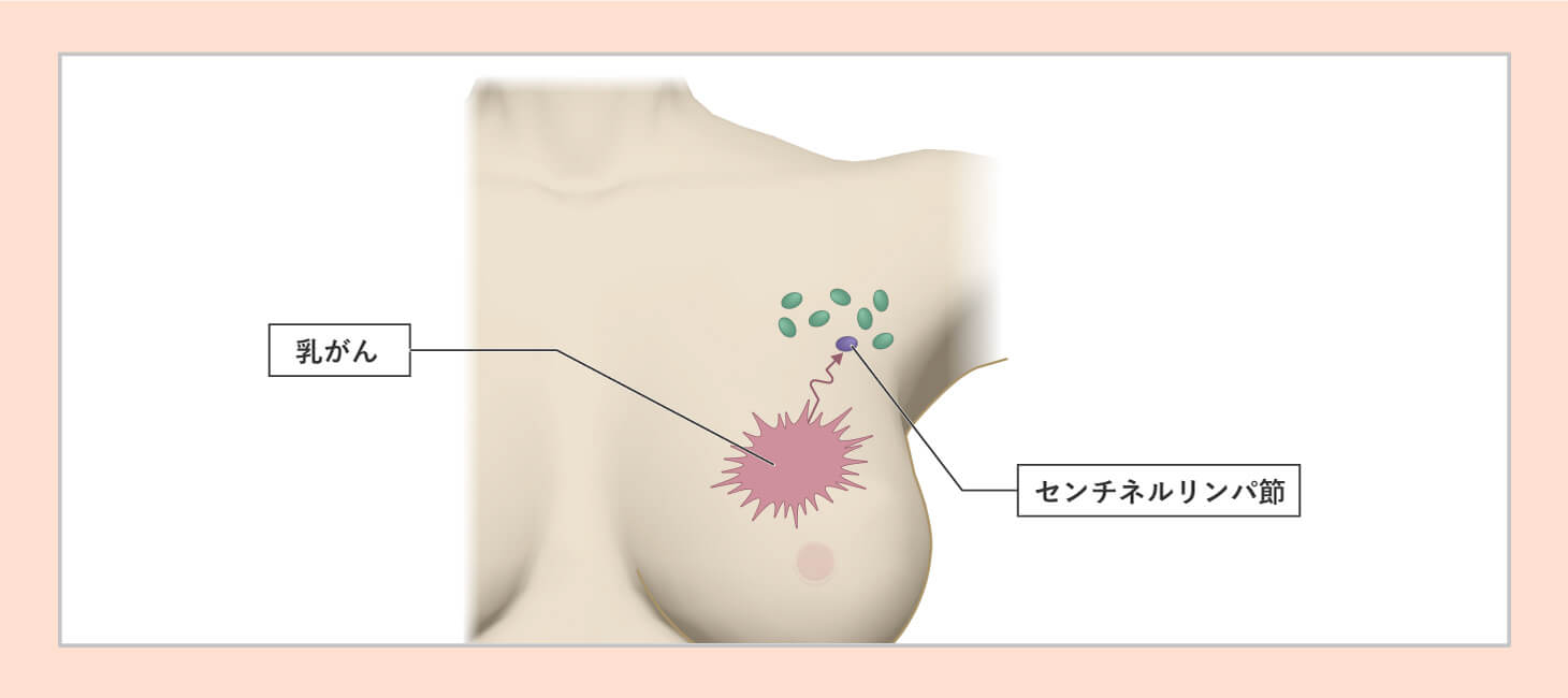 センチネル生検の図