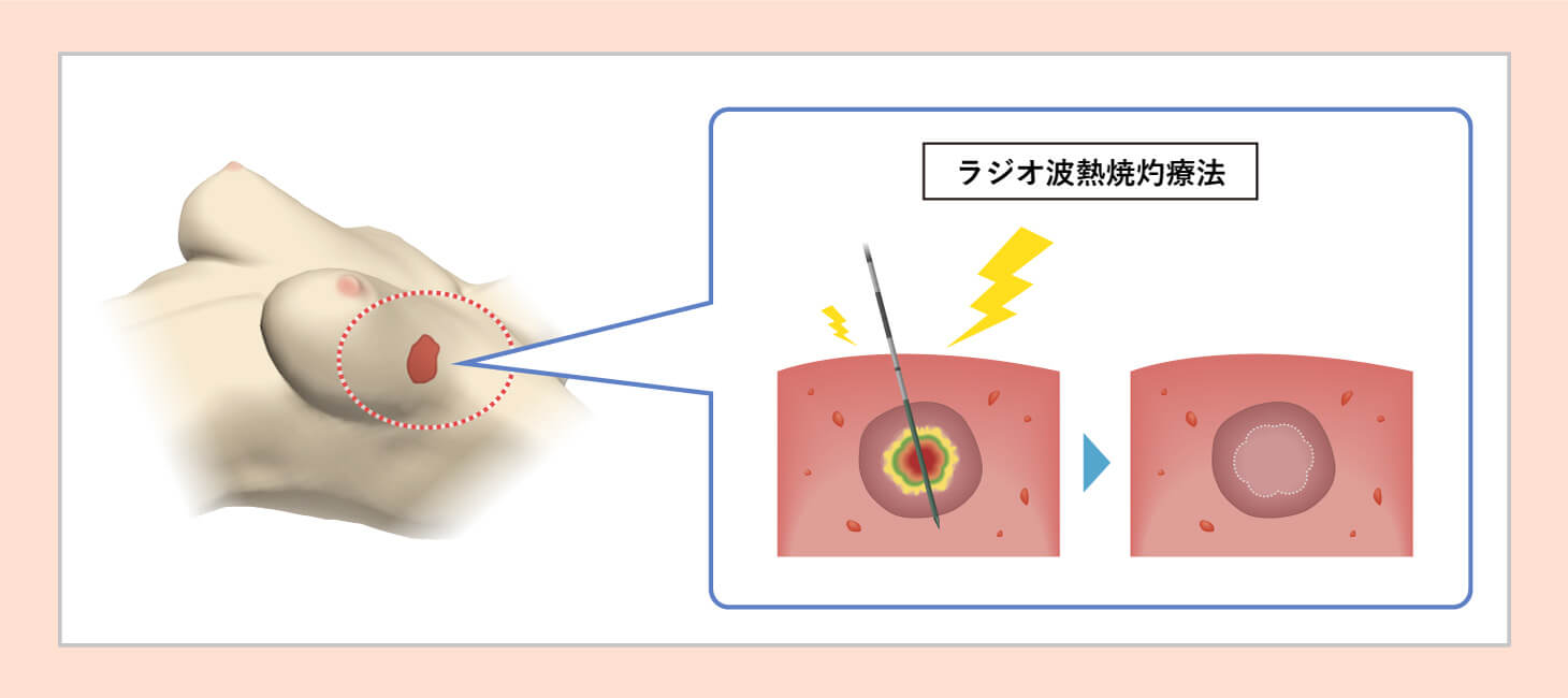 ラジオ波熱焼灼療法の図