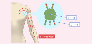 乳がん手術後のむくみ(リンパ浮腫)の予防と早期発見イメージ画像