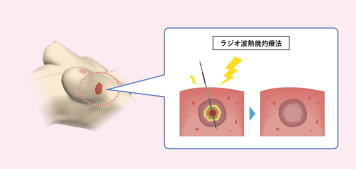 乳がんを先進医療で切らずに治すのイメージ画像