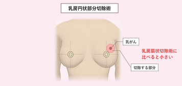 乳がんの手術療法 乳房の温存と乳房再建術のイメージ画像