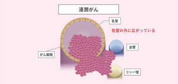 乳がんのステージを知ることの重要性のイメージ画像