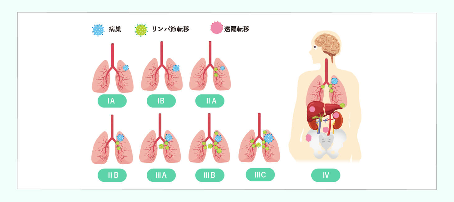 肺がんの治療法選択のイメージ画像