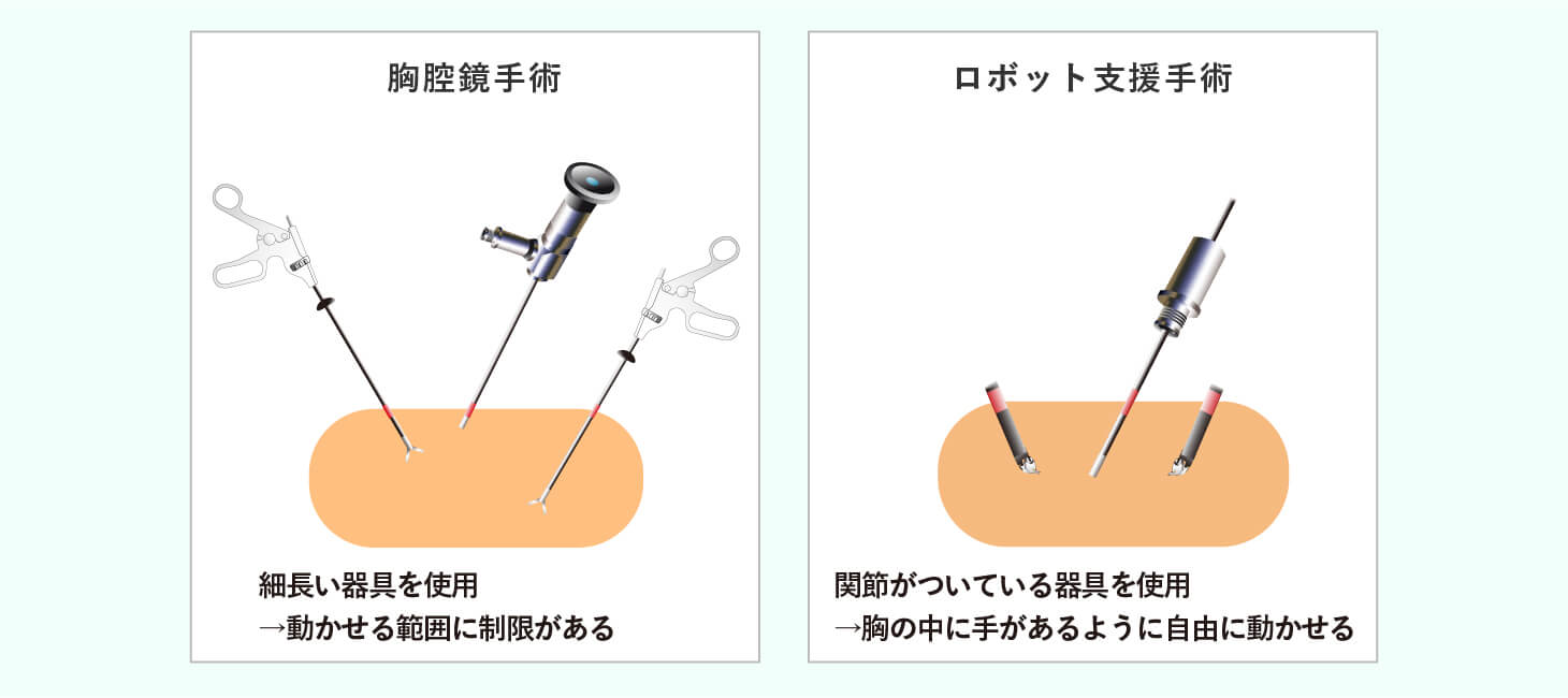 ロボット支援手術(ダヴィンチ手術)で内視鏡手術の精度が向上のイメージ画像