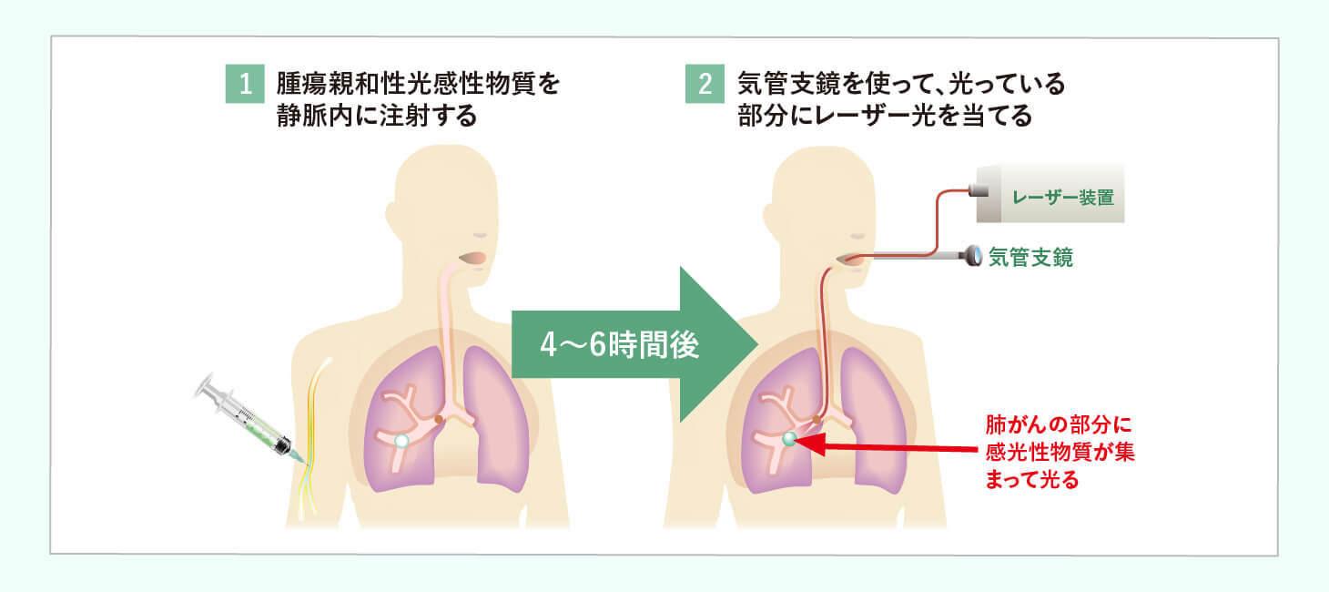非小細胞肺がん ステージⅠ~ⅢAのイメージ画像