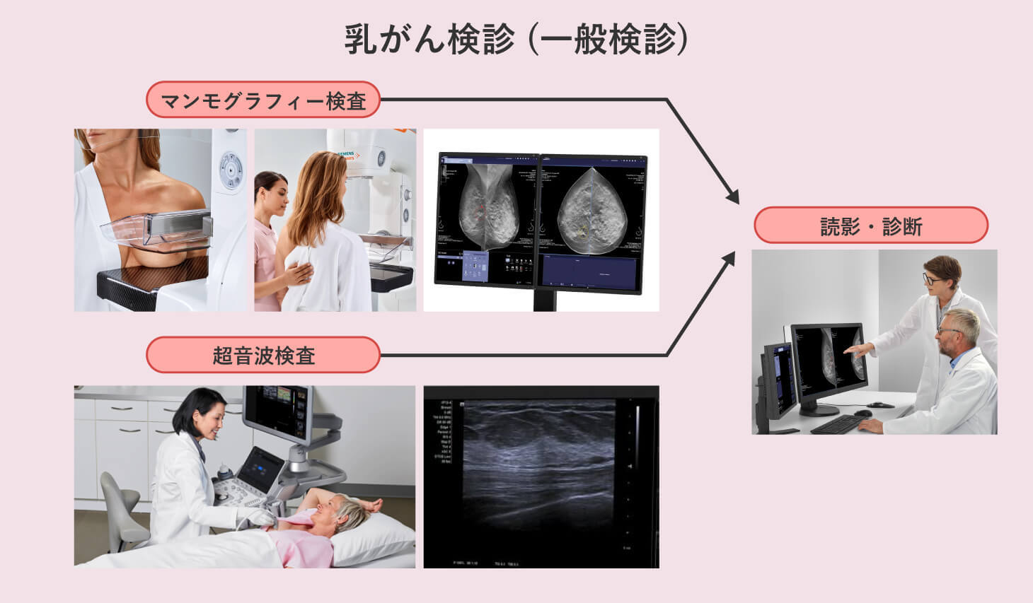 乳がん検診の図