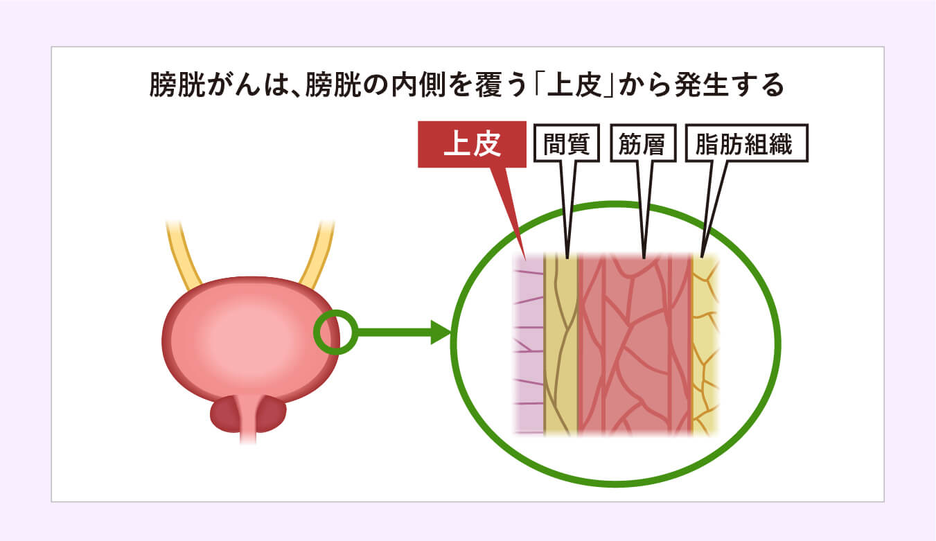 膀胱がんは、膀胱の内側を覆う「上皮」から発生する