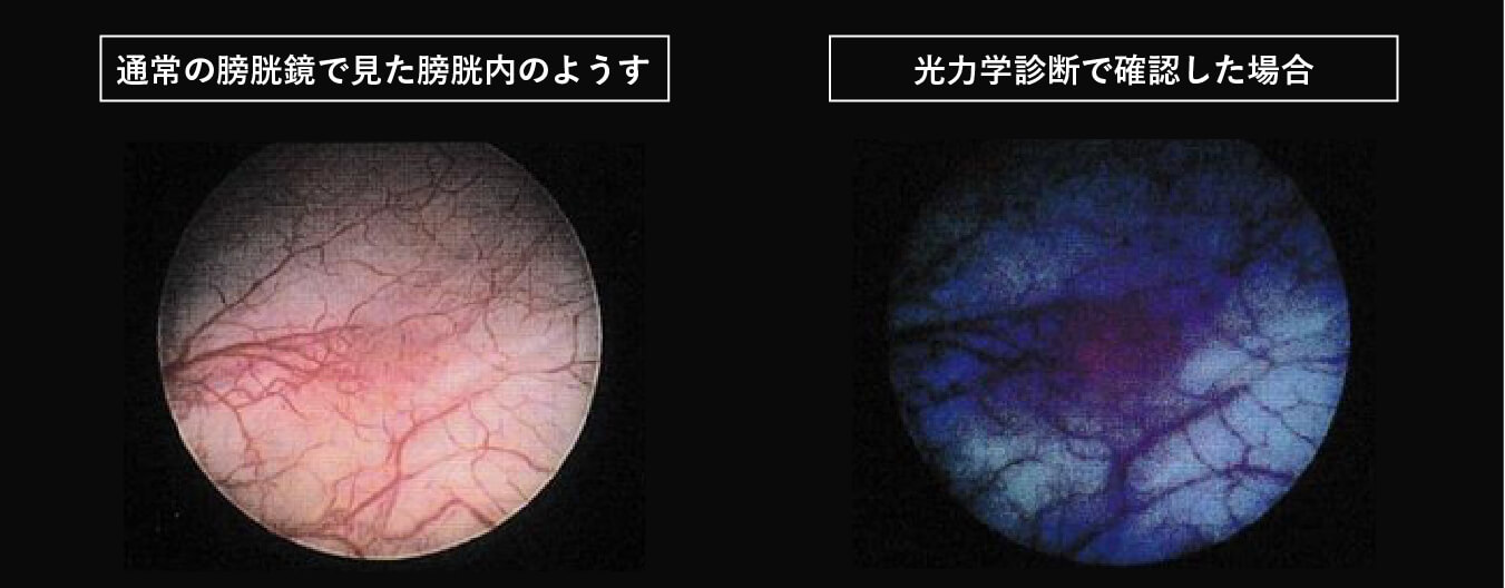 通常の膀胱鏡で見た膀胱内のようすと光力学診断で確認した場合