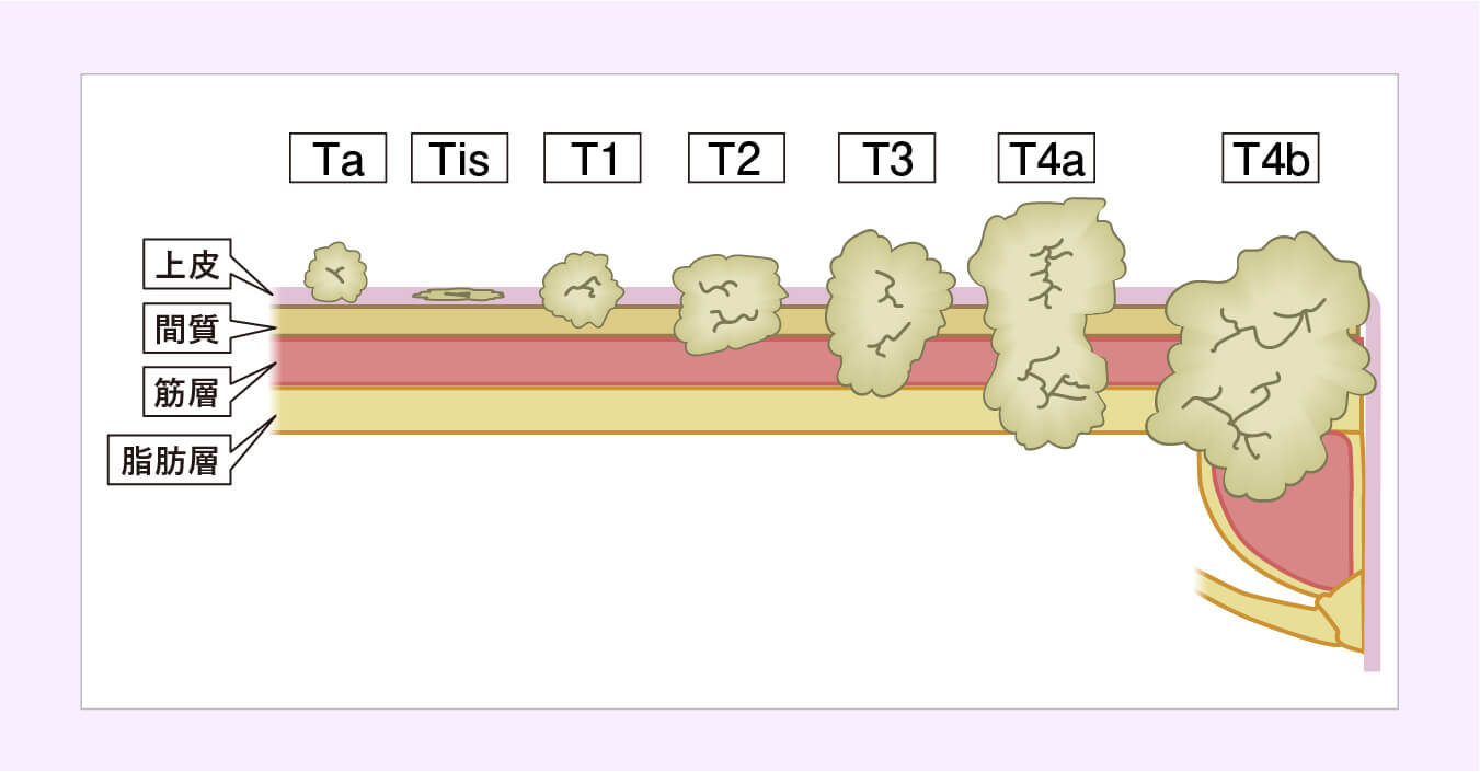 T因子(がんの深さ、広がり方)の図