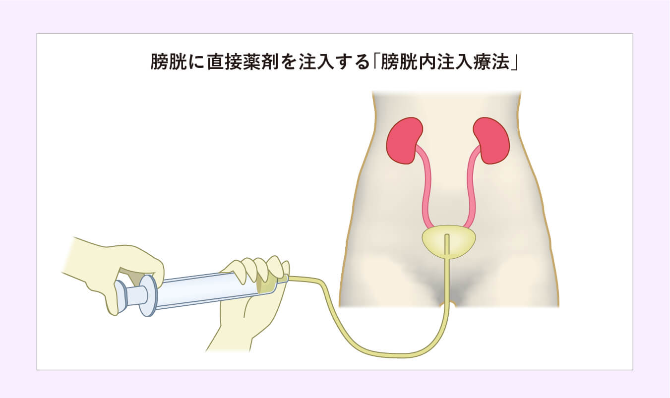 膀胱に直接薬剤を注入する「膀胱内注入療法」