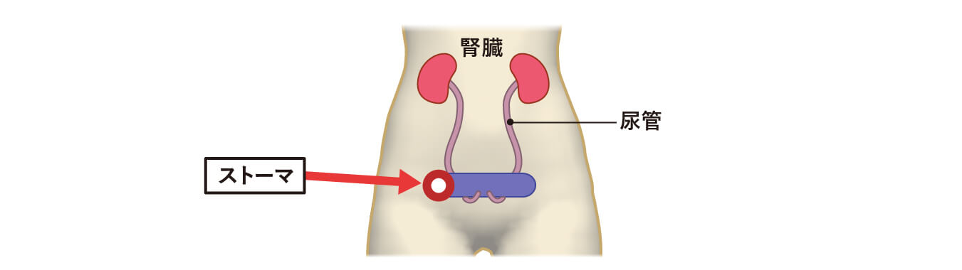 回腸導管(かいちょうどうかん)造設術