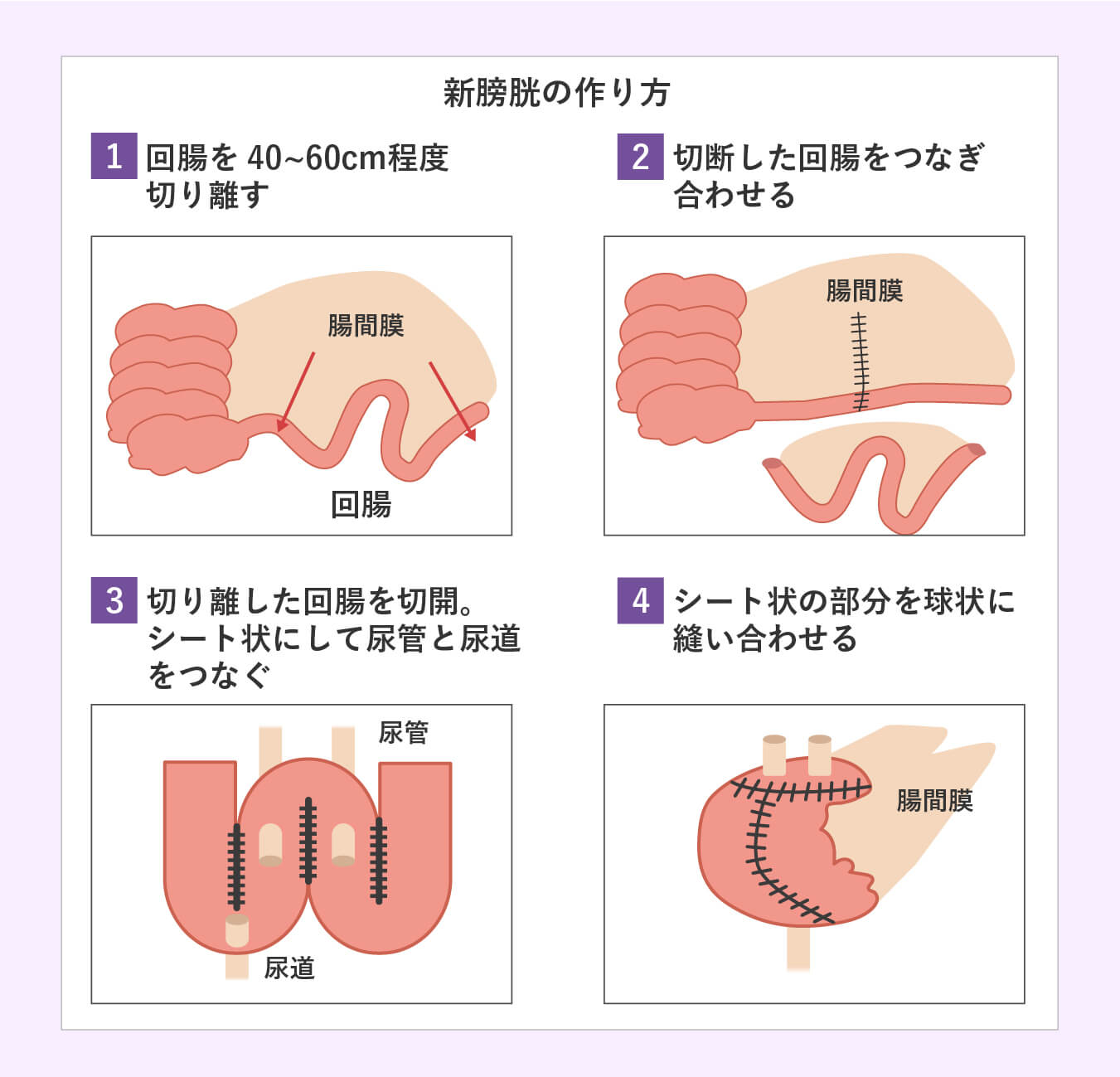 新膀胱の作り方