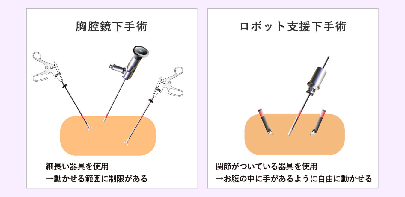 腹腔鏡下手術とロボット支援下手術のアーム比較