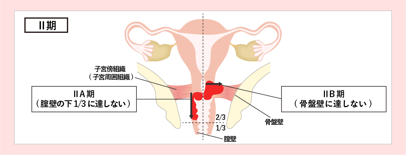 子宮頸がんのステージ2期