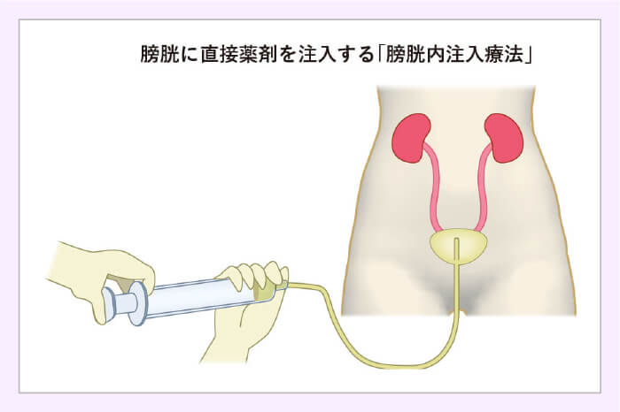 膀胱がんの手術後はどうなりますか?
