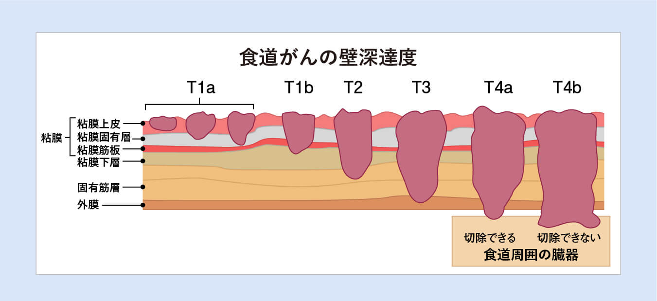 食道がんの壁深達度