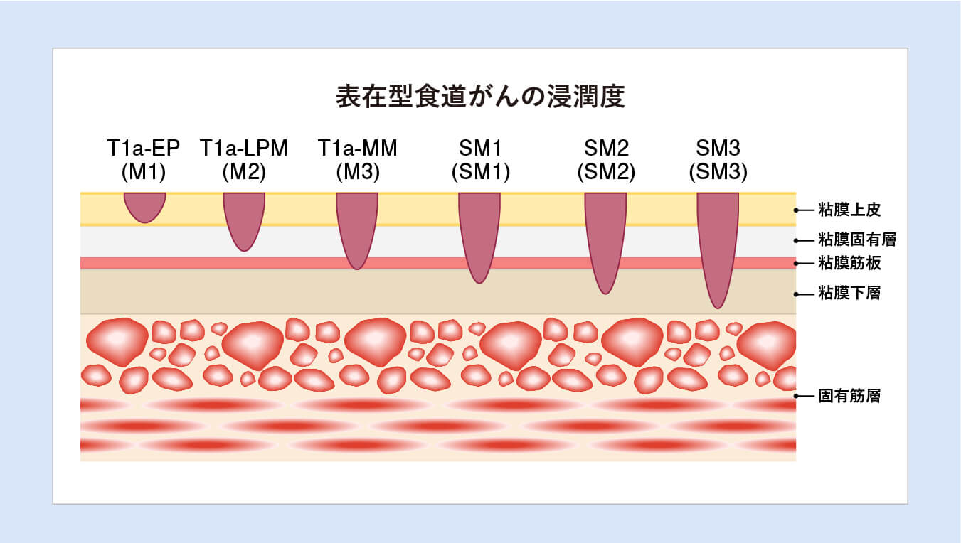 表在型食道がんの浸潤度