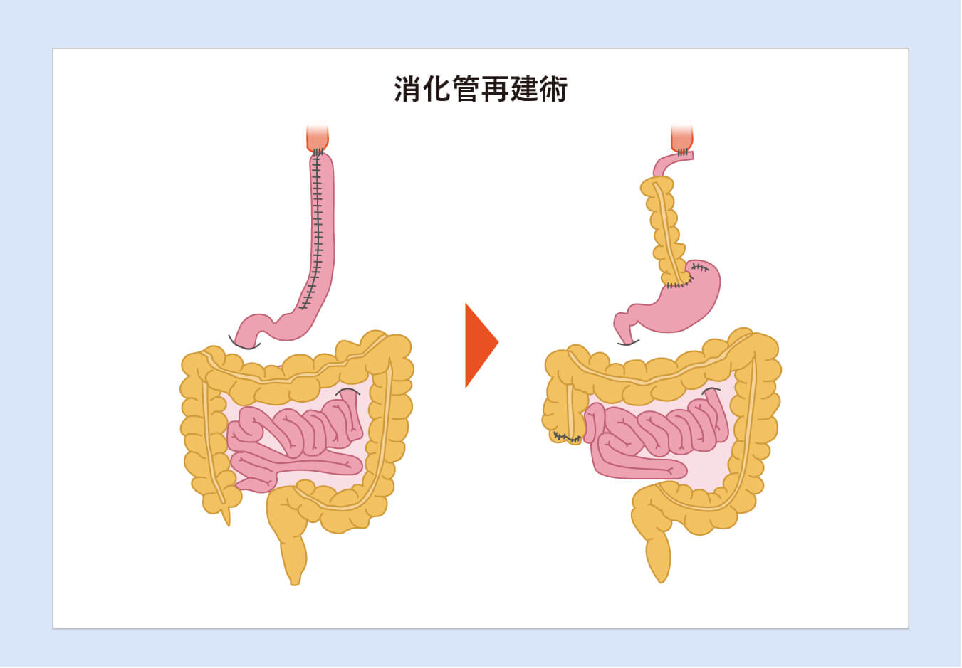消化管再建術
