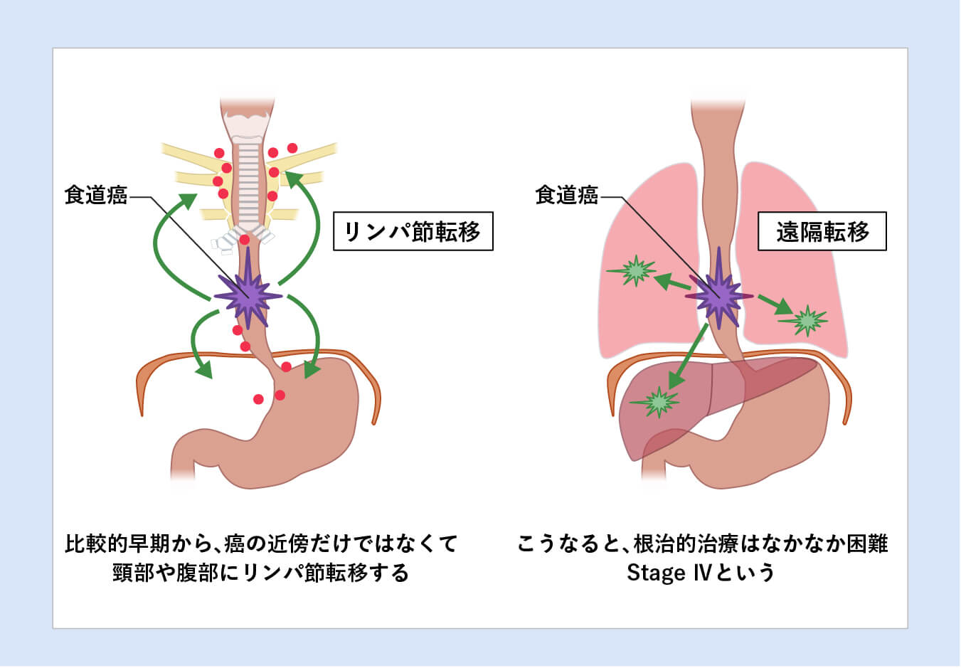 リンパ節、肺、肝臓や骨への転移