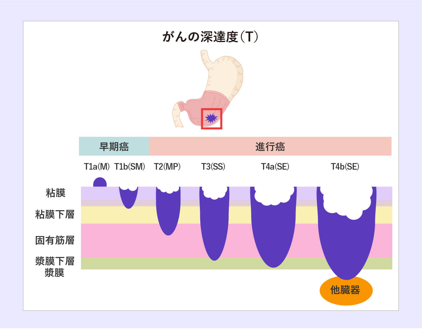 がんの深達度(T)