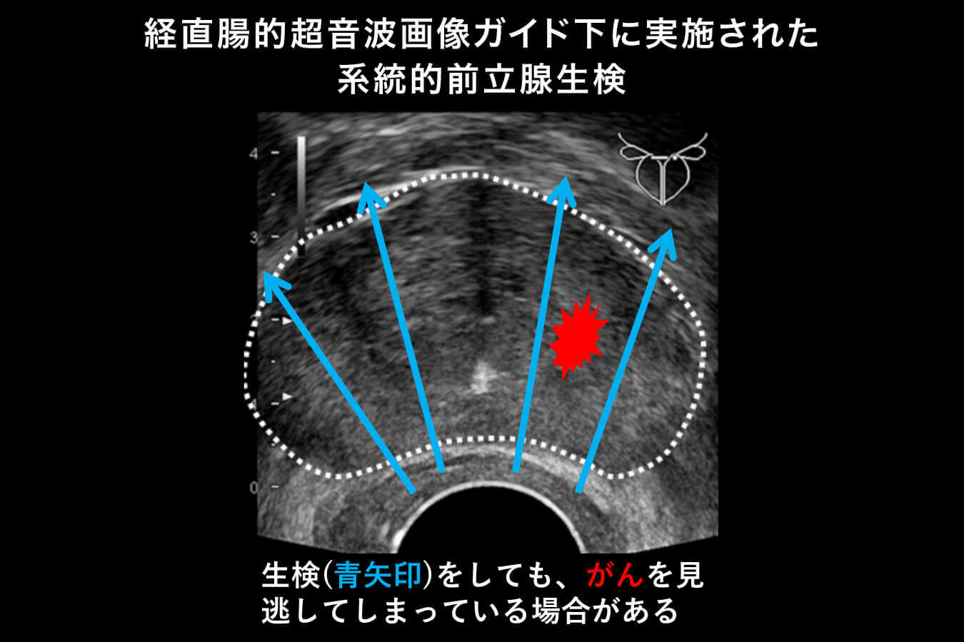 前立腺がんのその他の検査