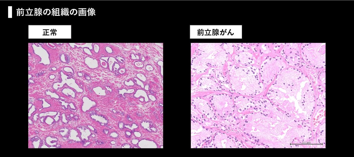 確定診断までの流れ - がんの治療法 詳しく知りたい！ 前立腺がん