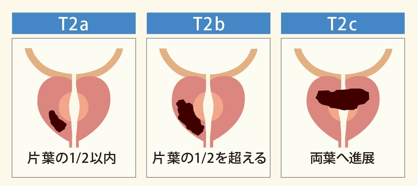 前立腺がんのステージ ステージ毎の詳細とグリソンスコアの関係 がんの治療法 詳しく知りたい